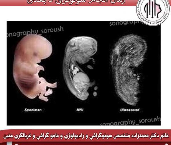 عکس سه بعدی رحم چیست