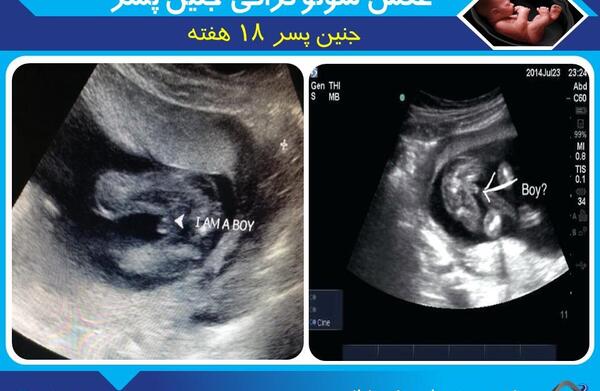 عکس سونوگرافی سه بعدی جنین پسر