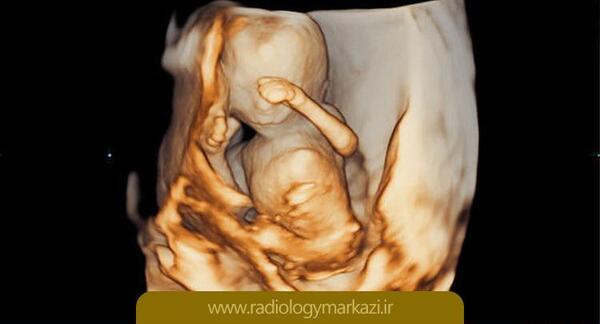 عکس سونوگرافی سه بعدی جنین پسر