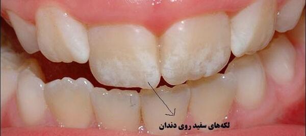 عکس دندان های سفید