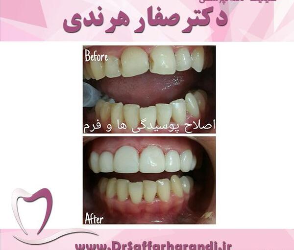 عکس دندان های سفید