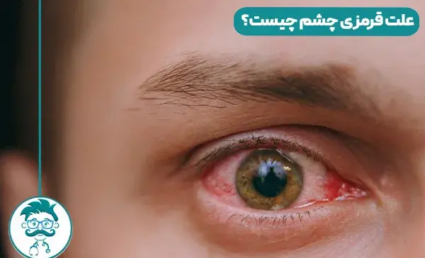عکس زرد شدن سفیدی چشم