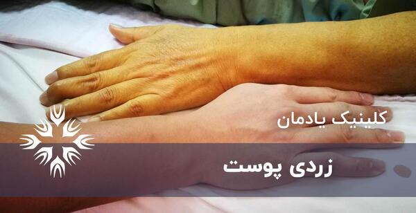عکس زرد شدن سفیدی چشم