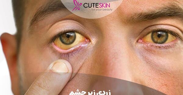عکس زرد شدن سفیدی چشم
