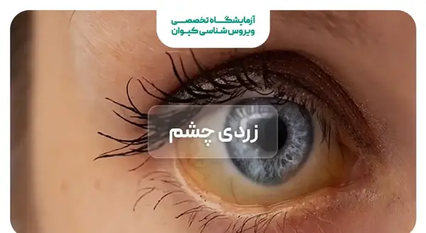 عکس زرد شدن سفیدی چشم