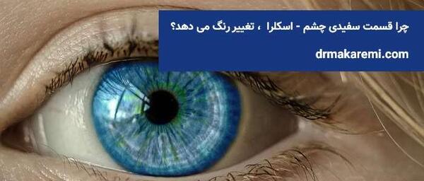 عکس زرد شدن سفیدی چشم