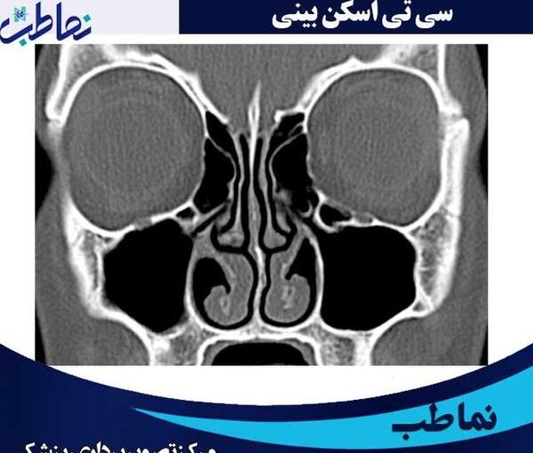 عکس سی تی اسکن ریه درگیر کرونا