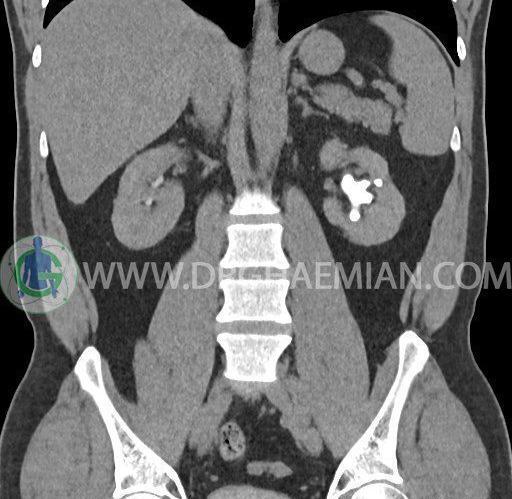 عکس سی تی اسکن ریه درگیر کرونا