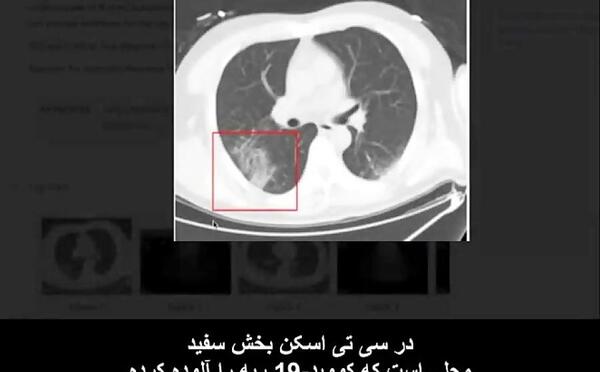 عکس سی تی اسکن ریه کرونایی