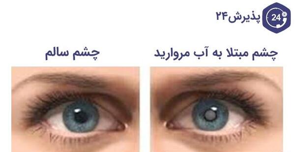 عکس آب مروارید در چشم