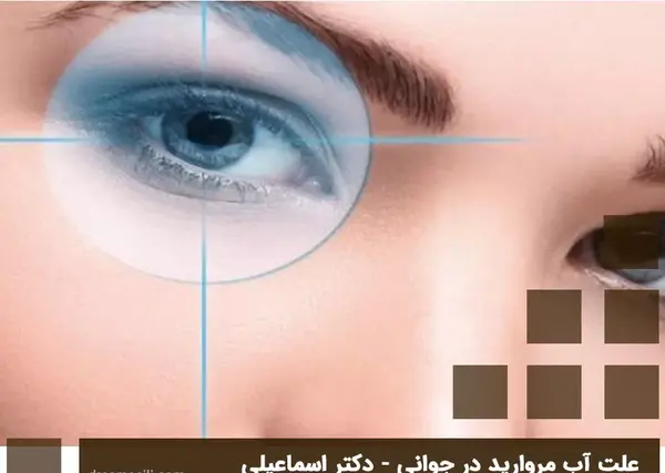 عکس آب مروارید در چشم