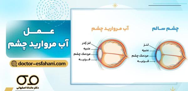 عکس آب مروارید در چشم