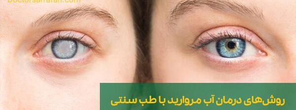 عکس آب مروارید در چشم