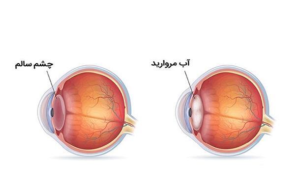 عکس آب مروارید در چشم