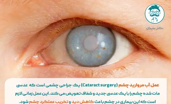 عکس آب مروارید در چشم
