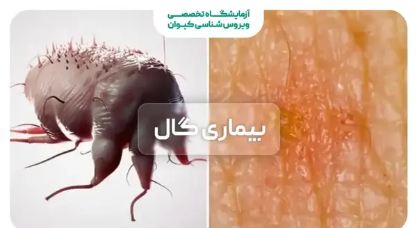 عکس تصاویر بیماری گال در کودکان