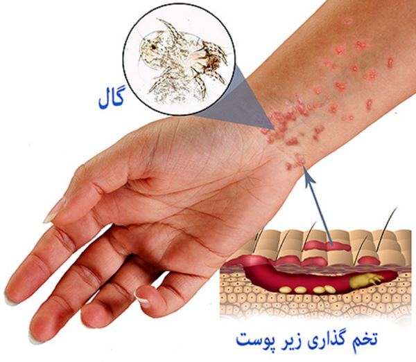 عکس تصاویر بیماری گال در کودکان
