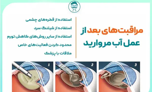عکس عمل چشم اب مروارید
