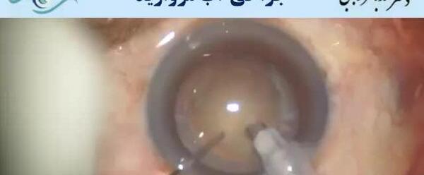 عکس عمل چشم اب مروارید