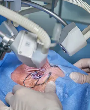 عکس عمل چشم اب مروارید