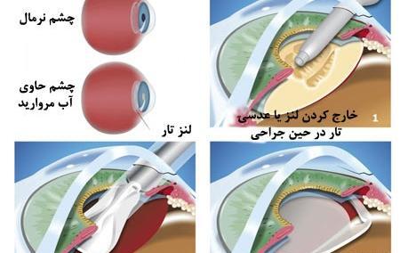 عکس عمل چشم اب مروارید