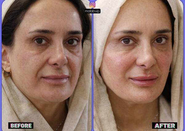 عکس ژل دور چشم