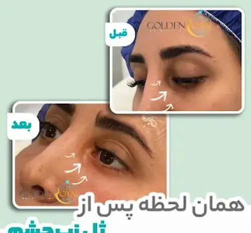 عکس ژل دور چشم