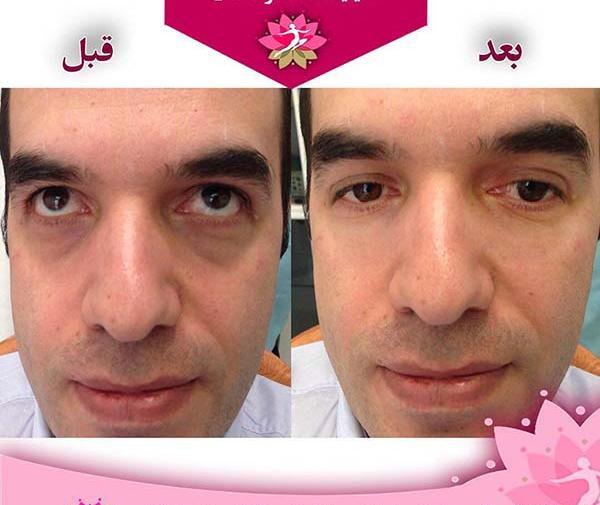 عکس ژل دور چشم