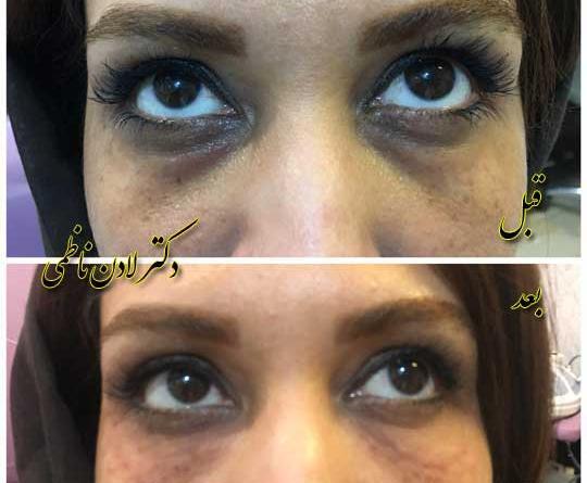 عکس ژل دور چشم