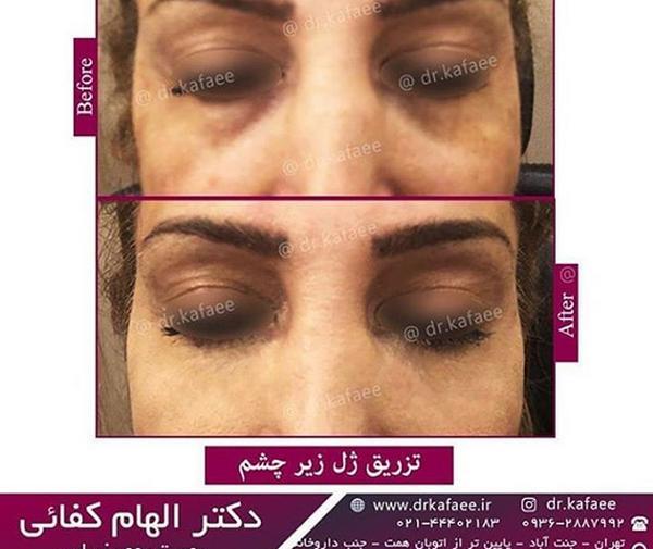 عکس ژل دور چشم