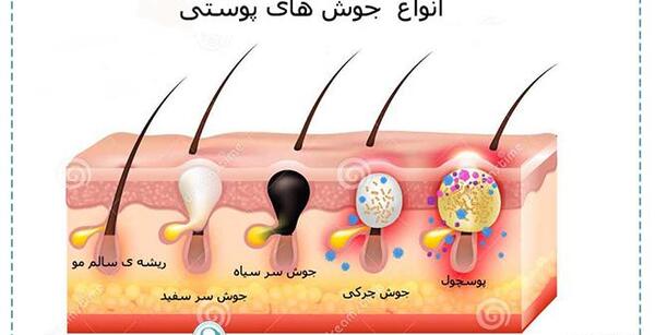 عکس انواع جوش بدن