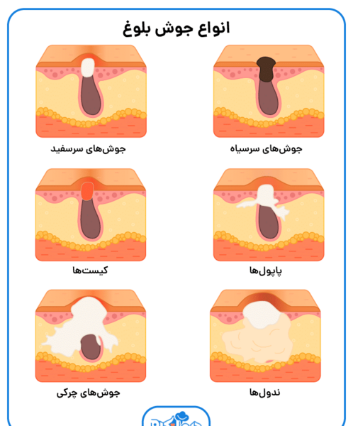 عکس انواع جوش بدن