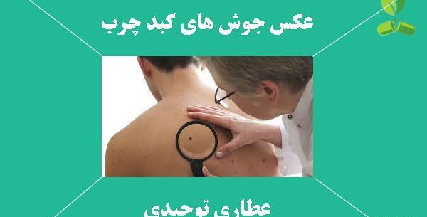 عکس انواع جوش بدن