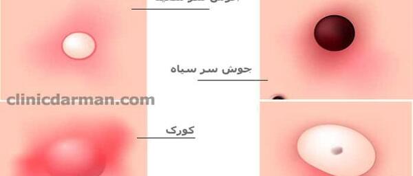 عکس انواع جوش بدن