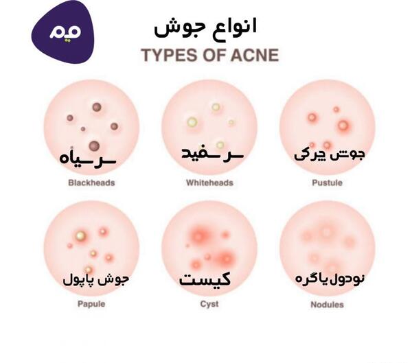 عکس انواع جوش بدن