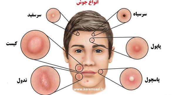 عکس انواع جوش بدن