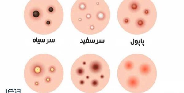 عکس انواع جوش بدن