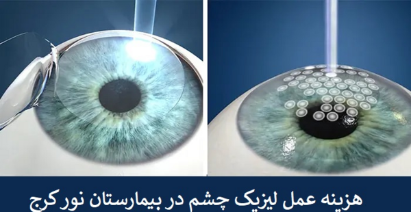 هزینه عکس چشم برای لیزیک