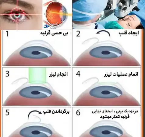هزینه عکس چشم برای لیزیک