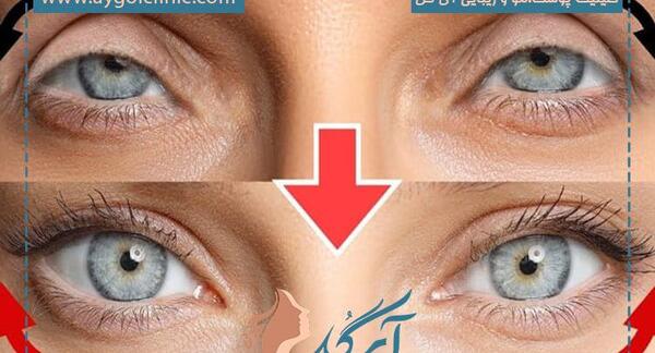 عکس عمل چشم روباهی