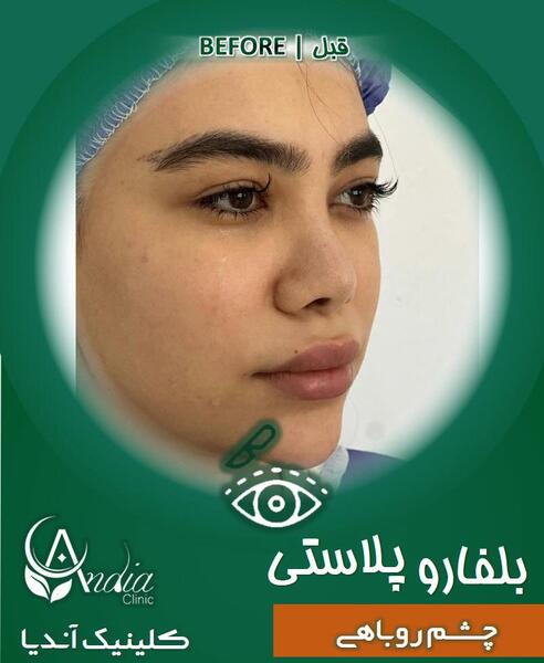 عکس عمل چشم روباهی