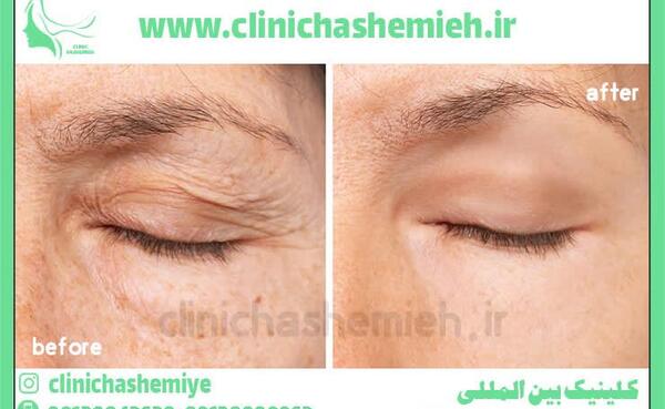 عکس عمل چشم روباهی