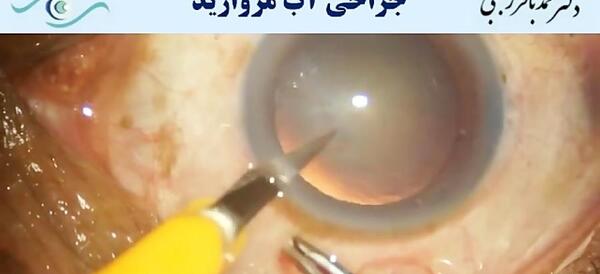 عکس چشم جراحی آب مروارید