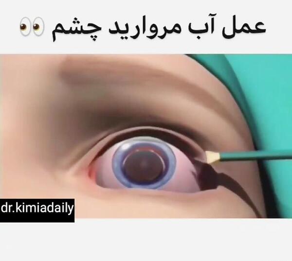 عکس چشم جراحی آب مروارید