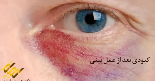 عکس زیر چشم کبود