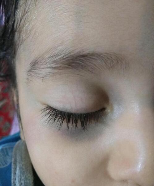 عکس زیر چشم کبود