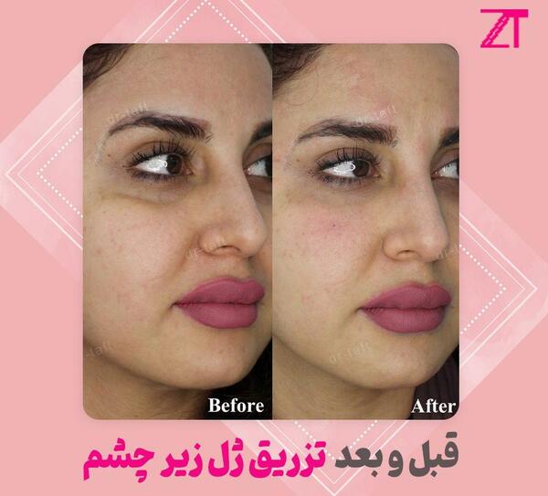 عکس زیر چشم کبود