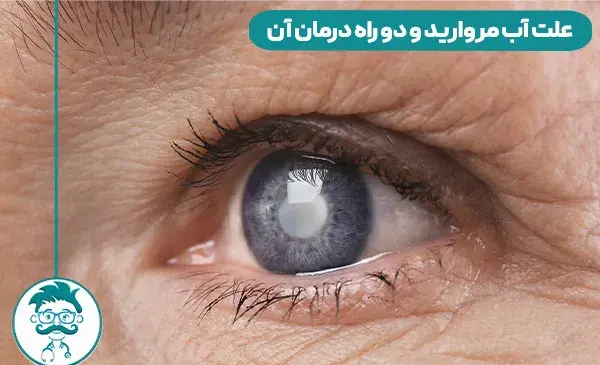 عکس چشم دارای اب مروارید