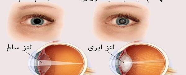 عکس چشم دارای اب مروارید
