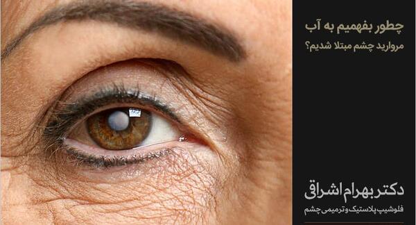 عکس چشم دارای اب مروارید